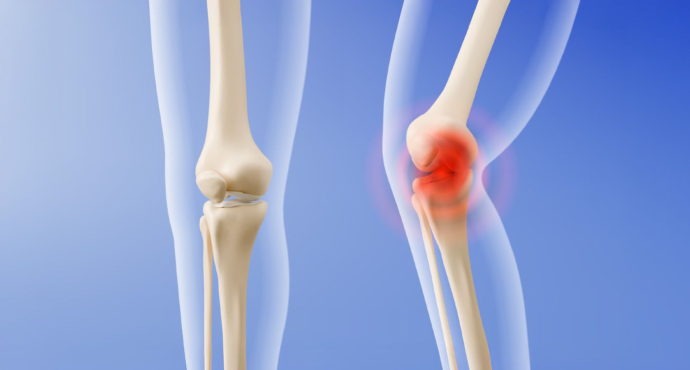 Smart Cartilage: The New Frontier Against Arthritis?